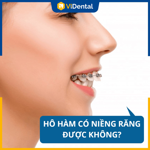 Nhiều người thắc mắc: Bị hô hàm có niềng răng được không?