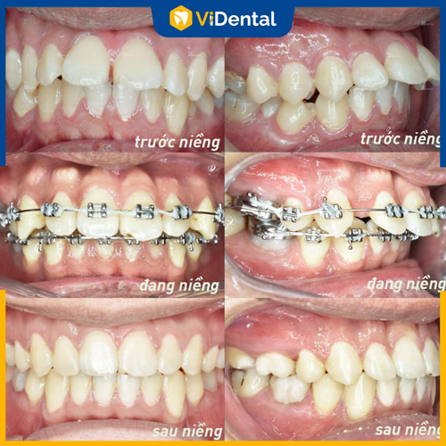 Nhiều ca hô hàm tại ViDental được cải thiện thành công sau khi niềng răng