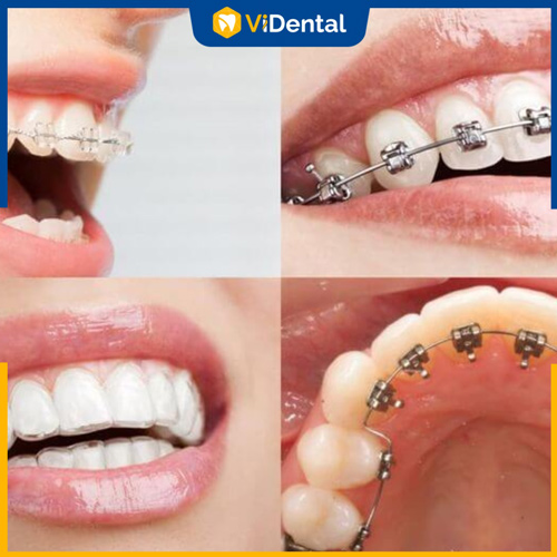 Nhiều trường hợp cần nhổ răng để có khoảng trống kéo răng, xương
