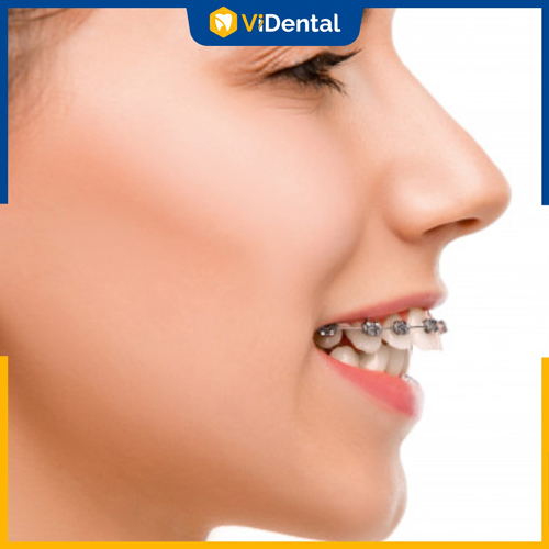 Nhiều người quan tâm đến phương pháp niềng răng hô 1 hàm