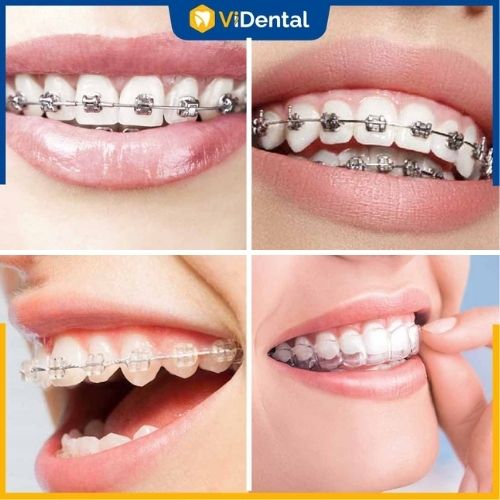 4 phương pháp niềng răng phổ biến