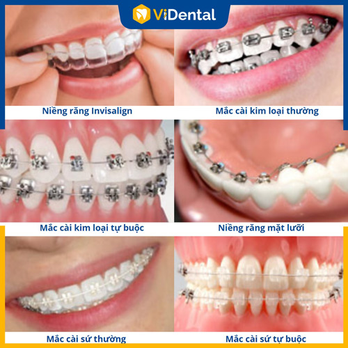 ViDental cung cấp đa dạng phương pháp niềng răng - chỉnh nha thẩm mỹ