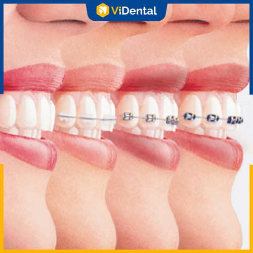 Niềng răng hơi hô mất bao lâu còn phụ thuộc vào nhiều yếu tố