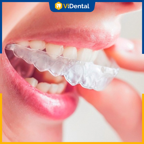 Hàm duy trì trong suốt giúp ổn định vị trí các răng sau khi chỉnh nha