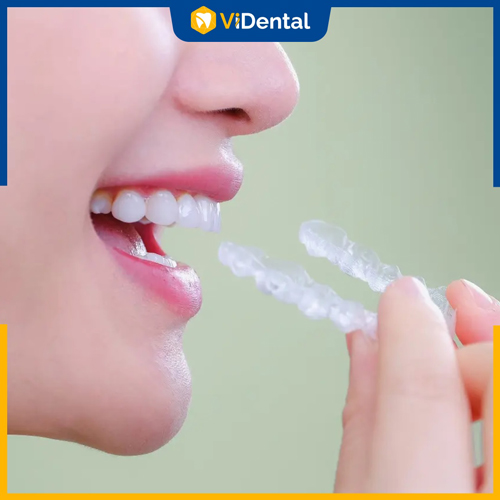 Sử dụng hàm duy trì điều chỉnh sau khi niềng răng