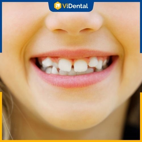 Những sai lệch về tình trạng răng miệng của trẻ nên được khắc phục sớm