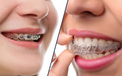 Niềng răng là cách dịch chuyển các vấn đề lệch lạc của hàm răng