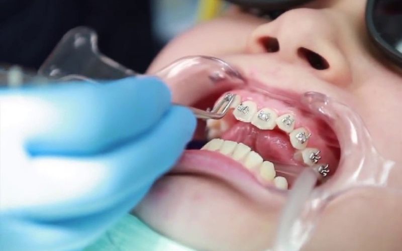 Quy trình niềng răng cơ bản đều tương tự nhau đối với mọi loại mắc cài