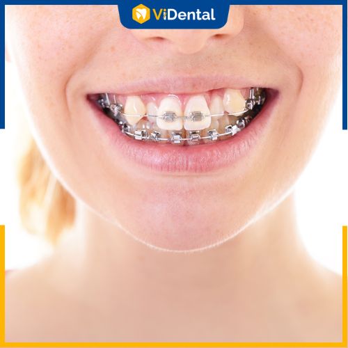 Niềng răng có thể cải thiện tình trạng mặt lệch do răng