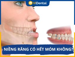 [CHI TIẾT] Chuyên Gia Giải Đáp: Niềng Răng Có Hết Móm Không?