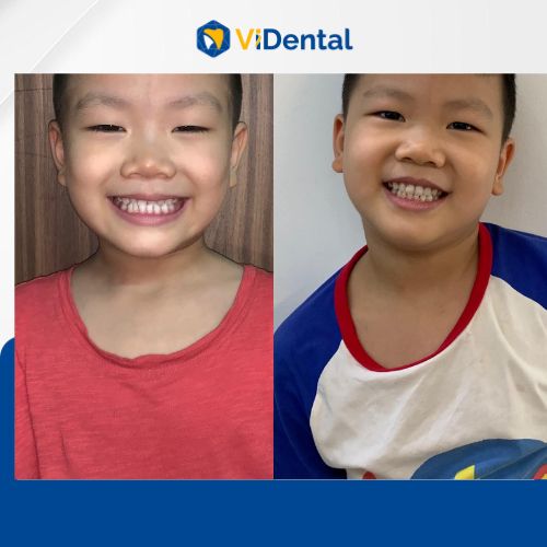 Nhiều bệnh nhân ở mọi độ tuổi đã niềng răng móm thành công tại ViDental