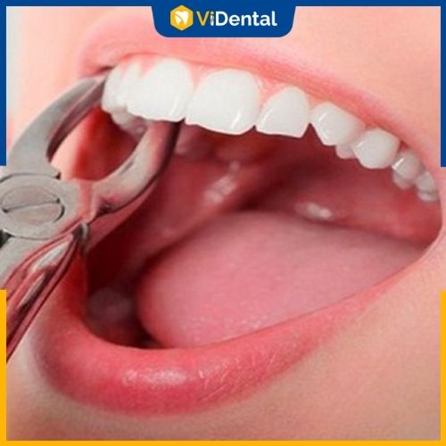 Phương pháp niềng răng khay trong suốt có cần nhổ răng không