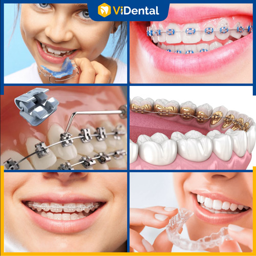 Có nhiều phương pháp chỉnh nha cho răng khểnh để bạn lựa chọn