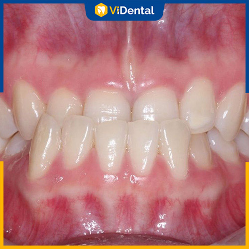 Niềng răng là phương pháp hiệu quả để khắc phục răng lệch khớp cắn