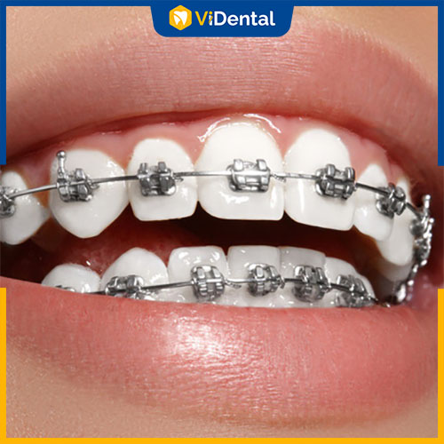 Có nhiều phương pháp niềng răng lệch khớp cắn khác nhau 