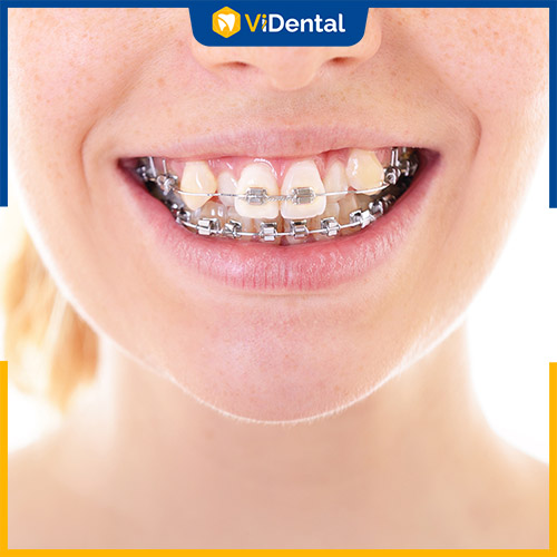 Niềng răng lệch lạc mất bao lâu phụ thuộc vào phương pháp bạn chọn