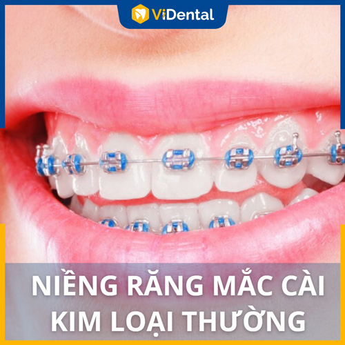 Niềng răng mắc cài kim loại thường là phương pháp chỉnh nha lâu đời