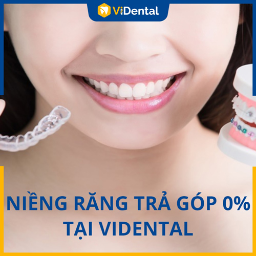 Giá cả cạnh tranh, chính sách trả góp 0% khi niềng răng tại ViDental