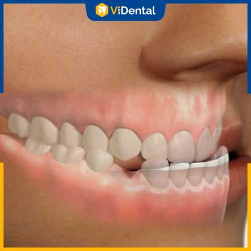 Phương pháp niềng răng giúp khắc phục tình trạng răng móm