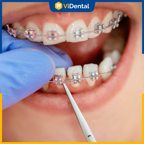 Niềng răng là giải pháp tối ưu nhất cho răng móm, khớp cắn lệch