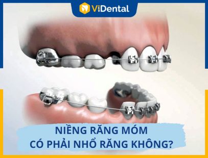 [Giải Đáp Chi Tiết] Niềng Răng Móm Có Phải Nhổ Răng Không?