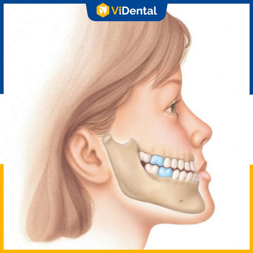 Việc nhổ răng để chỉnh nha thường chỉ định răng số 4, 5...