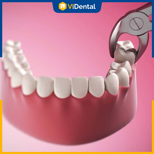 Nhổ răng để niềng răng móm cần chỉ định và thực hiện bởi bác sĩ uy tín