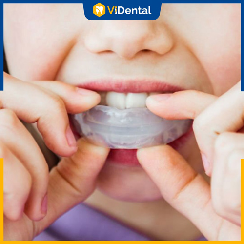 Lưu ý sử dụng đúng cách hàm niềng răng nhựa cho trẻ nhỏ