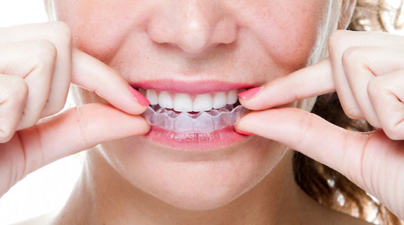 Giá niềng răng còn phụ thuộc vào nhiều yếu tố