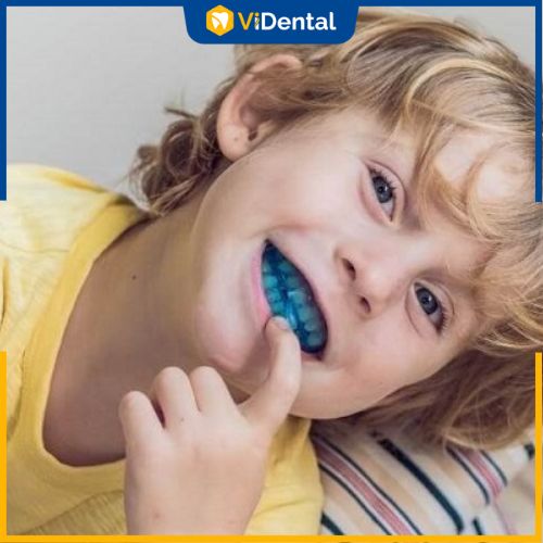 Khay hướng dẫn mọc răng được dùng trong giai đoạn thay răng sữa