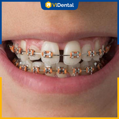 Niềng răng thưa với mắc cài kim loại truyền thống là phương pháp phổ biến nhất