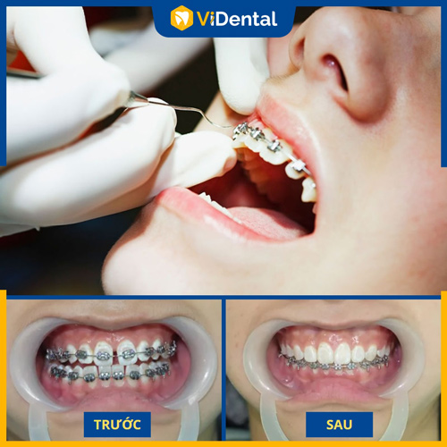 Thời gia niềng răng thưa thường từ 1 - 3 năm, phụ thuộc nhiều yếu tố