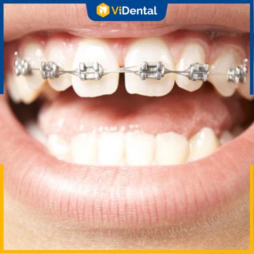 Để cải thiện tình trạng răng thưa, niềng răng là phương pháp tối ưu nhất