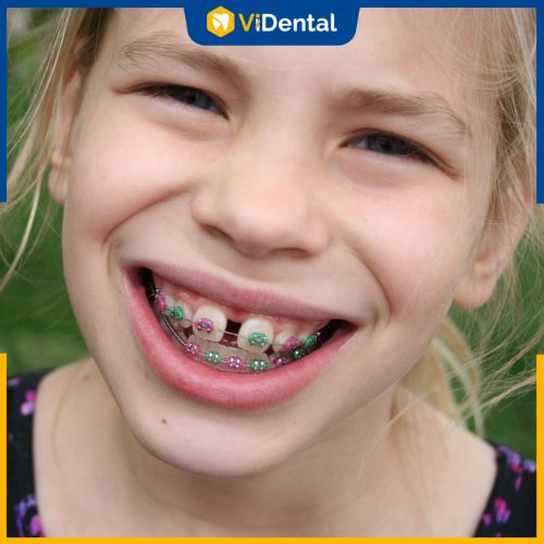 Thời gian niềng răng thưa cho trẻ em thường kéo dài từ 6 - 12 tháng