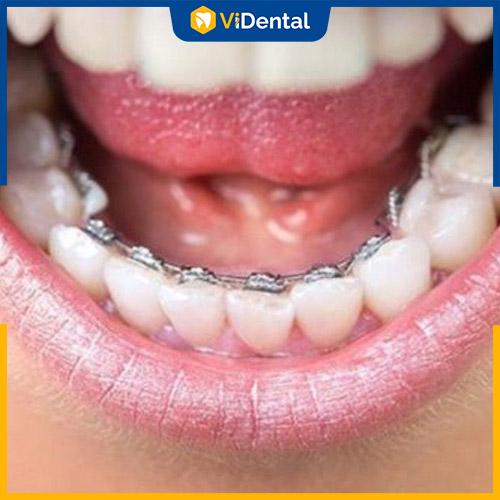 Niềng răng mắc cài là phương pháp hiệu quả khắc phục răng thưa