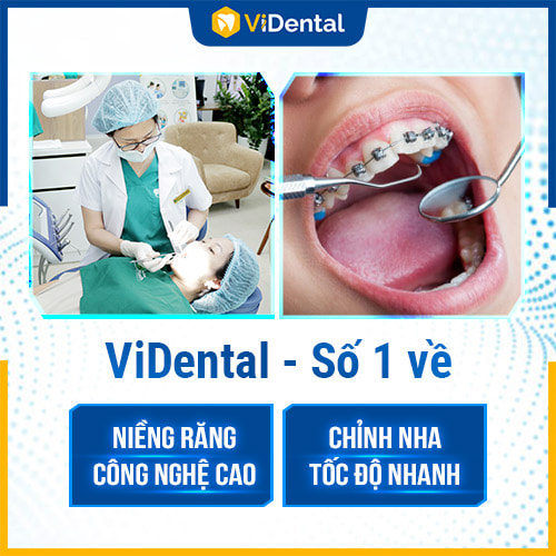 Vidental là địa chỉ niềng răng thẩm mỹ uy tín hàng đầu