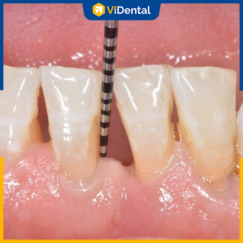 Hình ảnh răng thưa hàm dưới tạo kẽ hở rộng giữa 2 răng