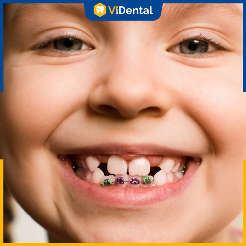 Niềng răng trẻ em là thủ thuật nha khoa thẩm mỹ được ưa chuộng