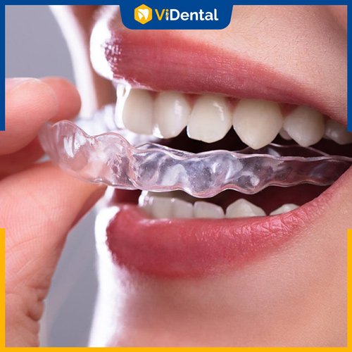 Niềng răng trong suốt là phương pháp chỉnh nha có tính thẩm mỹ cao nhất