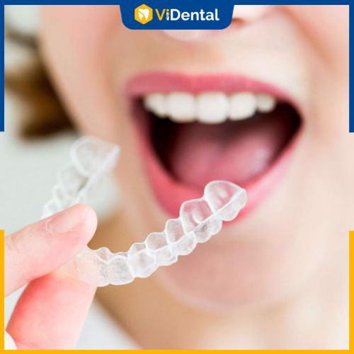 Niềng răng trong suốt là phương pháp chỉnh nha được lựa chọn phổ biến