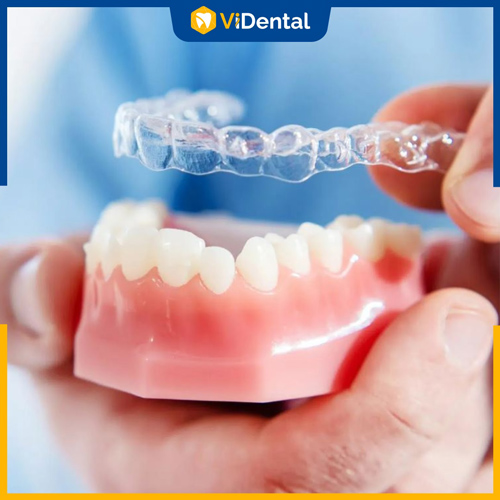 Nhiều yếu tố quyết định vấn đề nhổ răng tiền chỉnh nha Invisalign