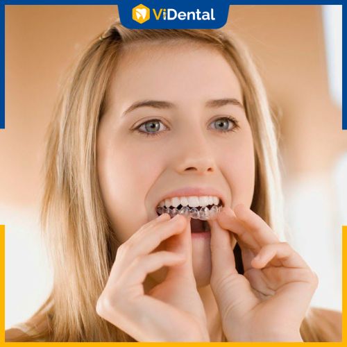 Niềng răng trong suốt Invisalign giá bao nhiêu - Ảnh hưởng bởi tình trạng răng