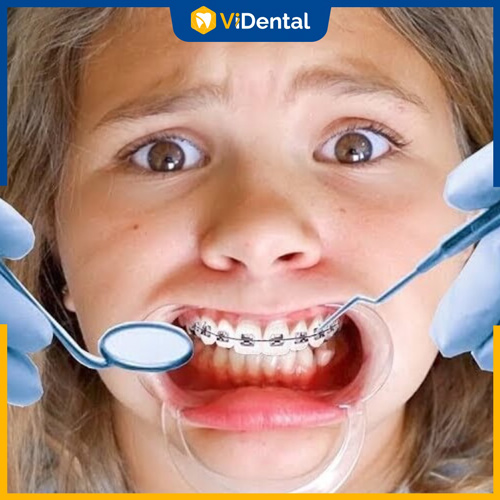 Nhiều nguyên nhân có thể khiến răng bị hô lại sau khi niềng