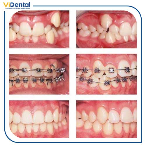 Quá trình niềng răng hô thường kéo dài từ 18 – 24 tháng