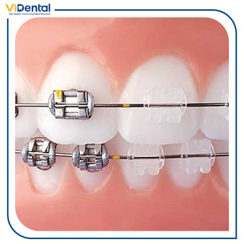 Niềng răng mắc cài sứ có nhiều ưu điểm hơn so với kim loại
