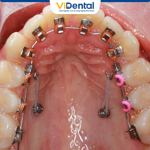 Khi niềng răng mặt lưỡi, các mắc cài được gắn vào bên trong