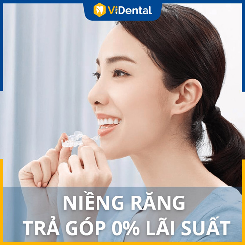 Trả góp 0% lãi suất - Giải pháp tiết kiệm chi phí niềng răng