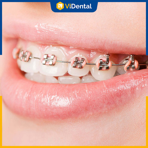 Niềng răng khắc phục răng thưa hiệu quả, cho hàm răng đều đẹp