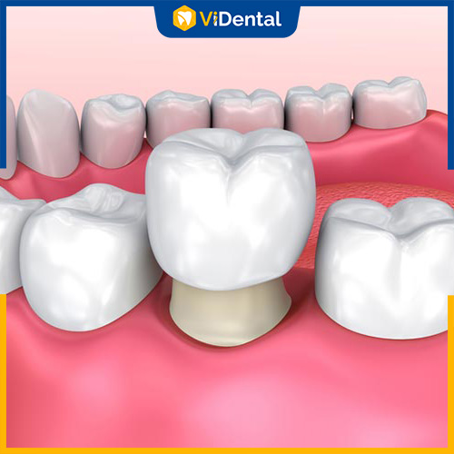 Bọc răng sứ cũng là cách khắc phục răng thưa hiệu quả