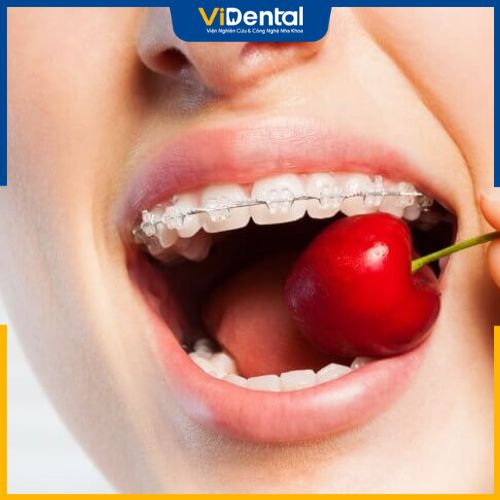 Lưu ý về chế độ ăn uống khi niềng răng